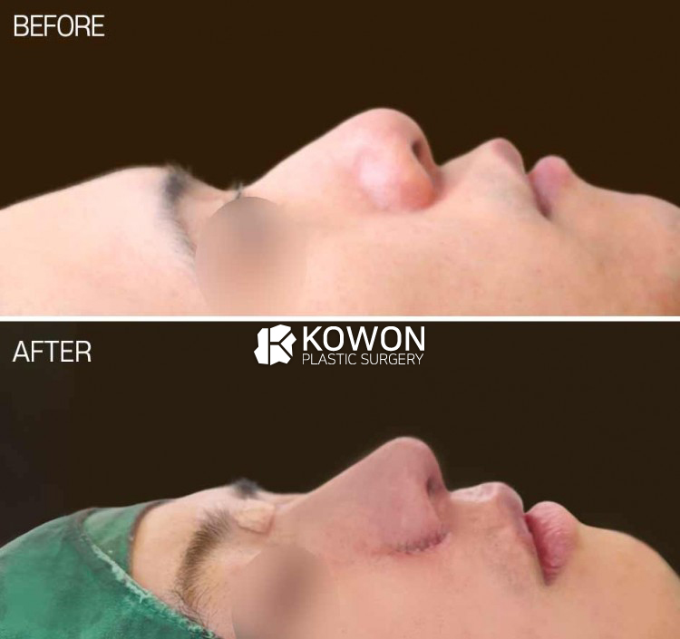 Male rhinoplasty before and after in Korea with hump nose correction, bulbous tip refinement and alar base reduction at KOWON Plastic Surgery Seoul.
