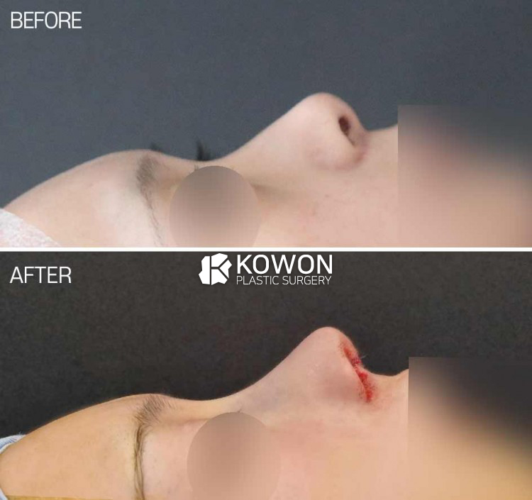 Upturned nose and short nose rhinoplasty before and after in Korea with nostril show reduction and alar rim correction at KOWON Plastic Surgery Seoul.