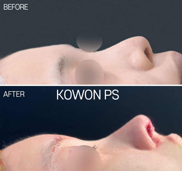 upturned-nose-correction-korea-before-after