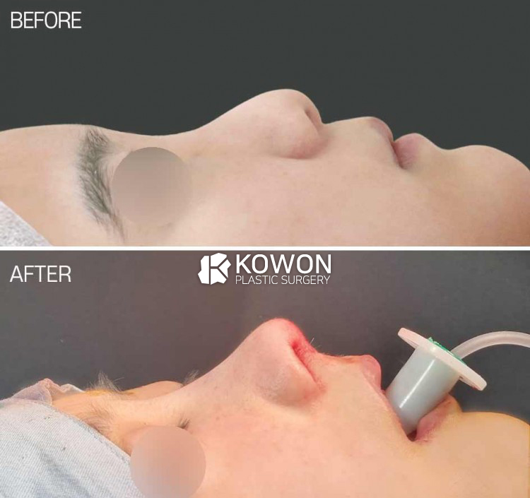 Bulbous Nose & Low Bridge Rhinoplasty Korea