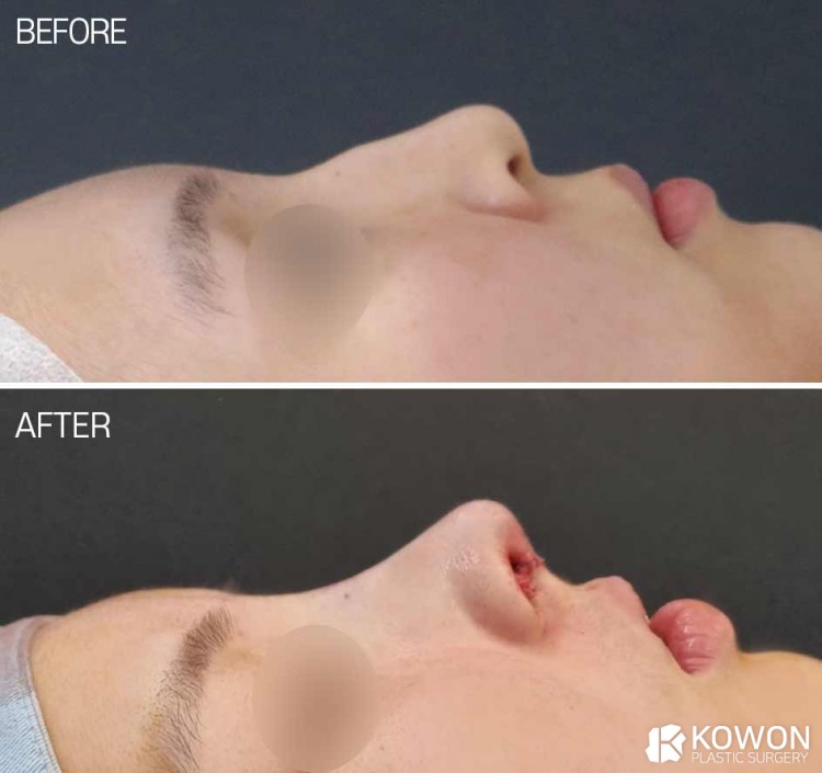 Alar Retraction Correction, Nostril Show Improvement