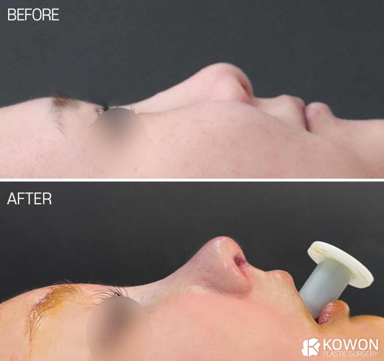 Bulbous Nose → Natural Glam